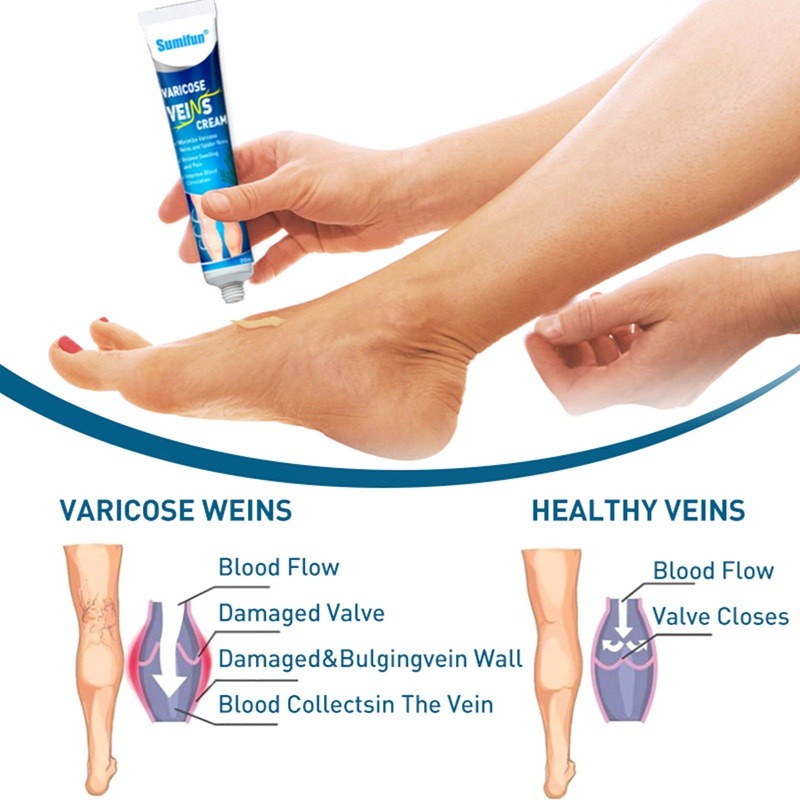 FreeShipping Buy 1 get 4 free Varicose vein body Cream Tendon-dredge body Cream