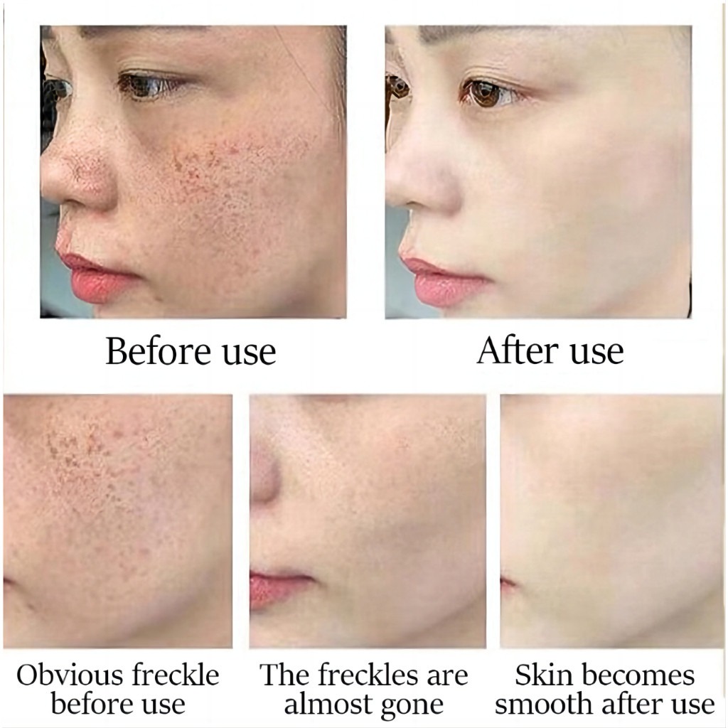 FreeShipping Philippines BUY 2 TAKE 3 Japanese Melasma Cream Yunnan Herbal Whitening Freckle Cream Original Whitening remover cream for face effective anti-aging FreeShipping Philippines BUY 2 TAKE 3 Japanese Melasma Cream Yunnan Herbal Whitening Freckle Cream Original Whitening remover cream for face effective anti-aging